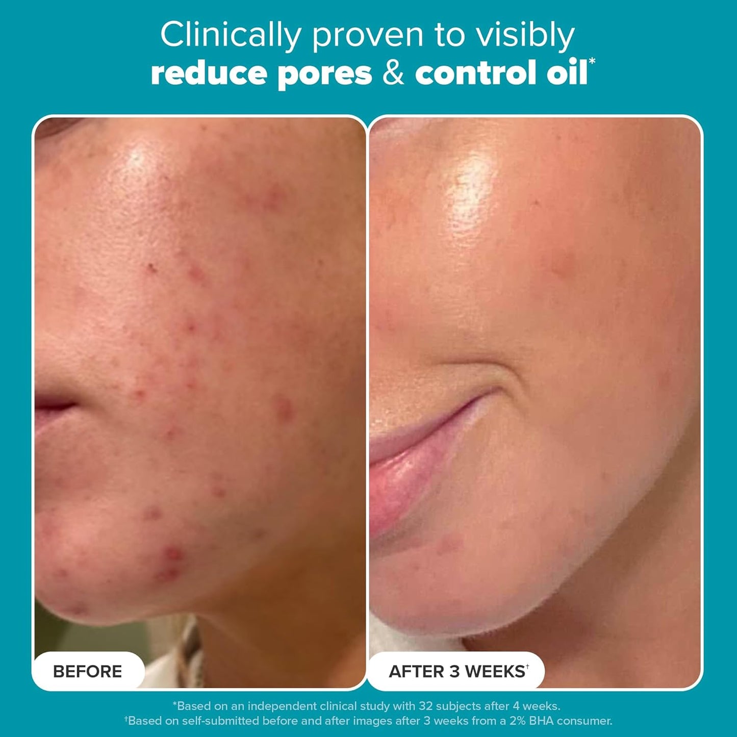 SKIN PERFECTING 2% BHA Liquid Salicylic Acid Exfoliant-Facial Exfoliant for Blackheads, Enlarged Pores, Wrinkles & Fine Lines