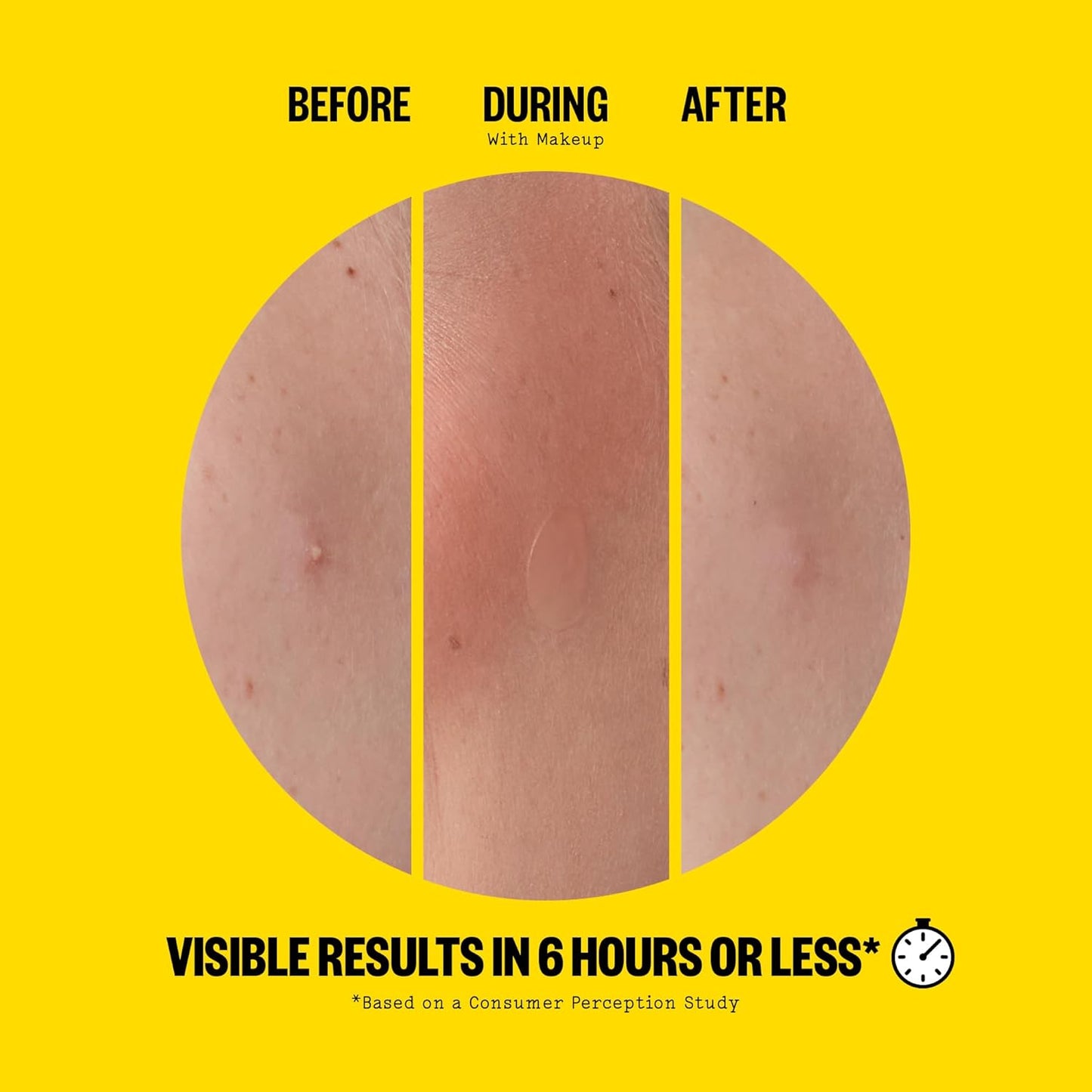 Acne Day Dot, Sheer Acne Healing Dots, Virtually Invisible Wear, Hydrocolloid Pimple Patches Helps Clear Blemishes Quickly with Encapsulated Salicylic Acid, Retinol & Aloe Vera, 20 Dots