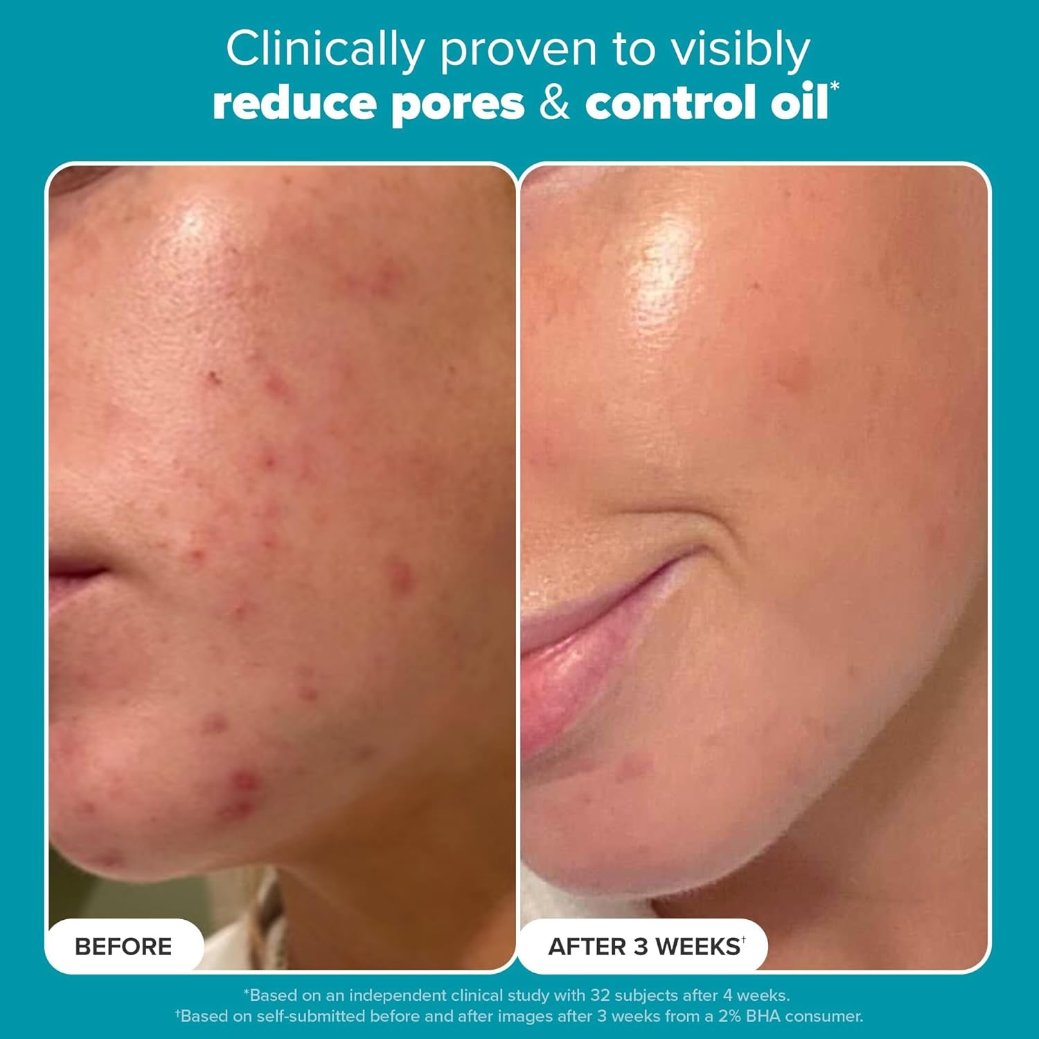 SKIN PERFECTING 2% BHA Liquid Salicylic Acid Exfoliant-Facial Exfoliant for Blackheads, Enlarged Pores, Wrinkles & Fine Lines